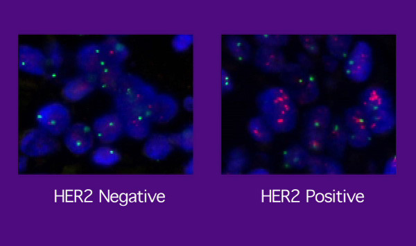  Различие между HER2 негативными и HER2 позитивными клетками