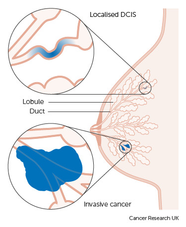Различие между карциномой  in citu и инфильтративным протоковым раком груди