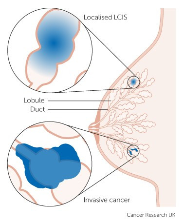 Различие между неинвазивным и инфильтративным дольковым раком груди