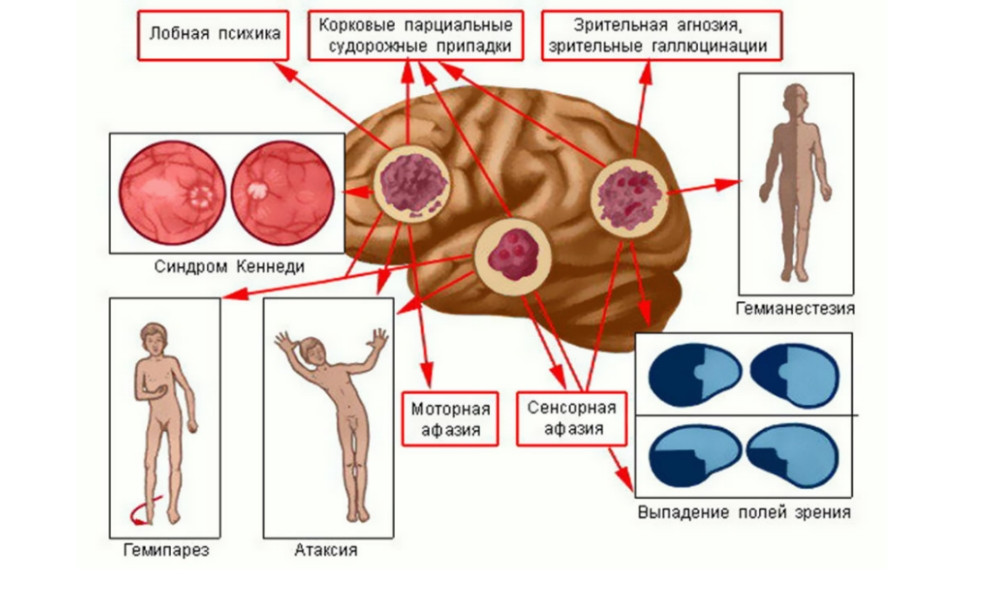 Различные проявления опухолей головного мозга