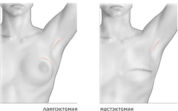 Хирургическое лечение рака груди: лампэктомия и мастэктомия