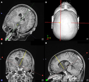 Определение мишени при стереотаксической биопсии головного мозга