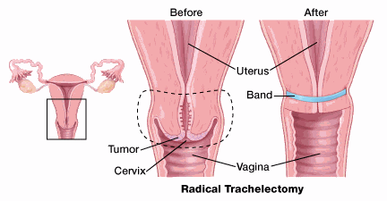 Трахелэктомия — операция по удалению шейки матки