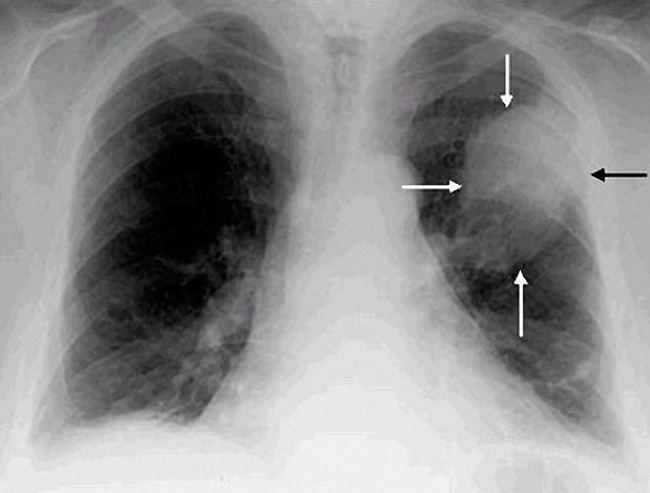 Центральный рак легкого на рентгеновском снимке