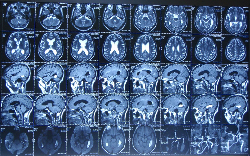 Полученные с помощью МРТ-сканирования головного мозга томограммы позволяют врачу с высокой точностью определить характер проблем