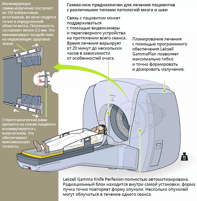 Инфографика – принцип устройства радиохирургической установки Гамма-нож