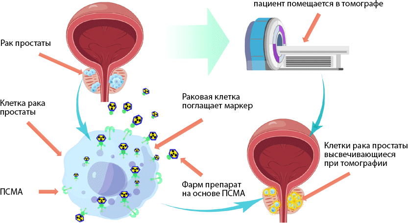 Схема проведения ПЭТ КТ простаты с ПСМА